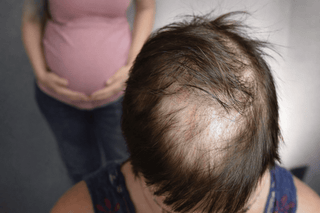 Hair Loss Treatment: Causes, Hormones, and the Most Effective Solutions - Greenway pharma