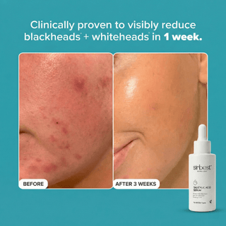 Sirbest Salicylic Acid 2% Face Serum 30 ml - Greenway pharma